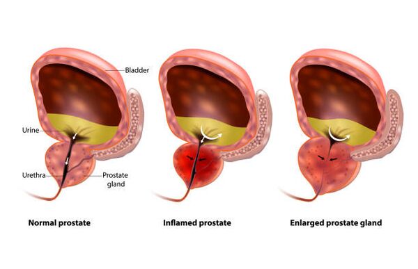 prostatit, prostat bezinin iltihaplanmasıdır