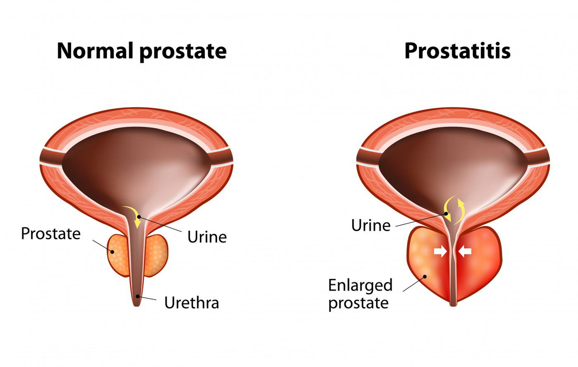Sağlıklı bir erkeğin normal prostatı ve prostatit ile prostat bezinin iltihabı