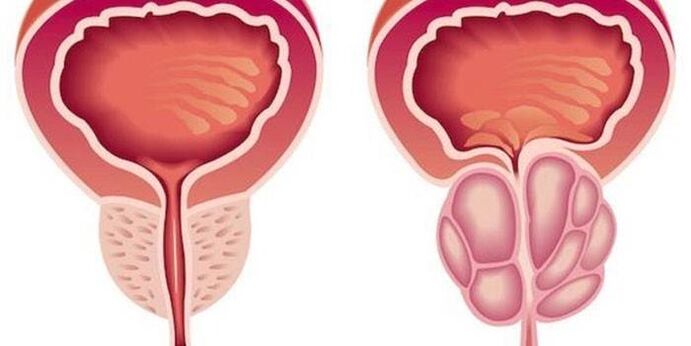 prostatit